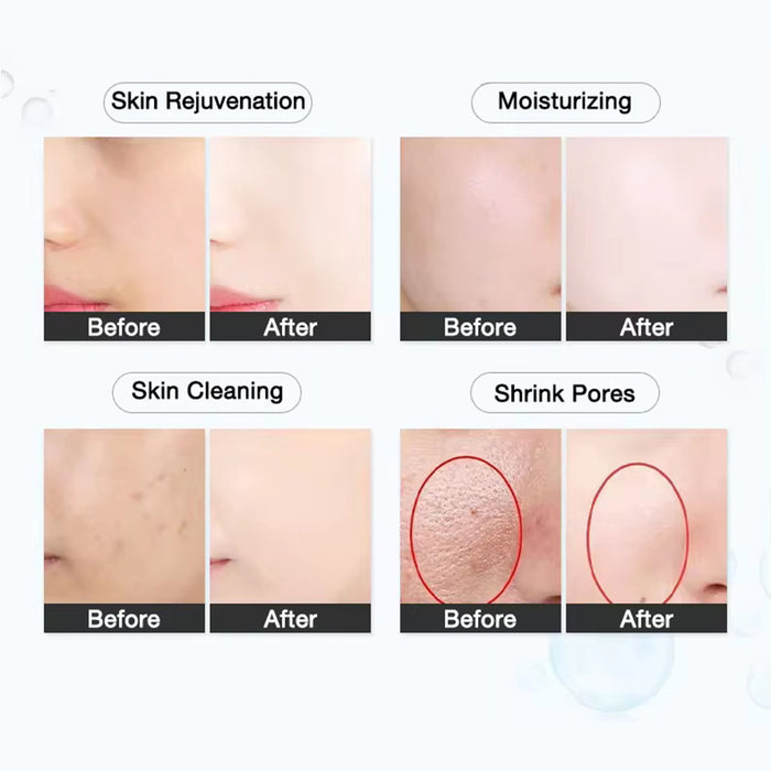 Svatar Cryo Therapy Electroporation Beauty Facial Mesotherapy Machine Esthetic Cryo Facial D Cool Machine
